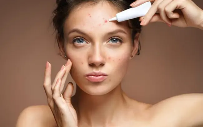 روش های از بین بردن جوش صورت در یک روز